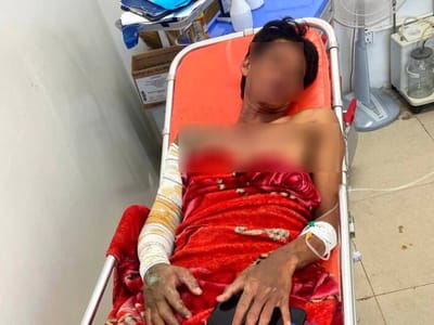 柬埔寨男子疑因婚外情遭到妻子放火烧伤